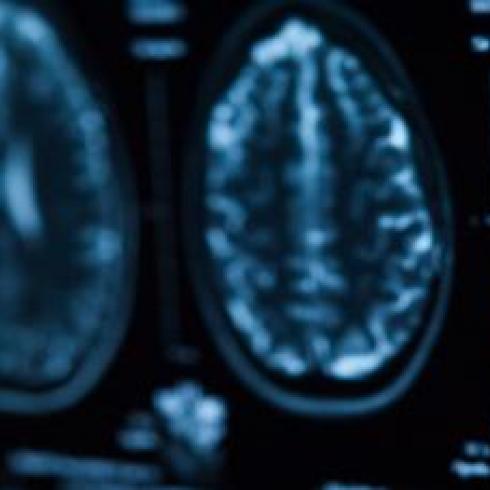 ALS: University of Padua Study Opens Up New Strategies to Slow Disease Progression