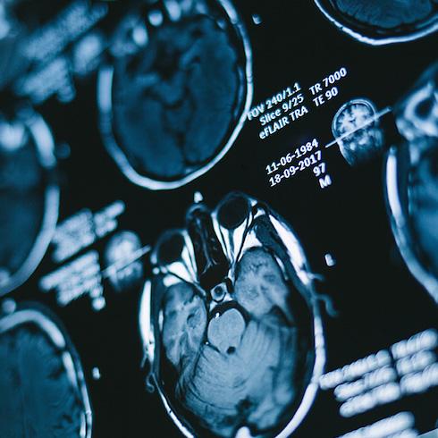 Artificial intelligence and resonance imaging: new methods for diagnosing brain tumours