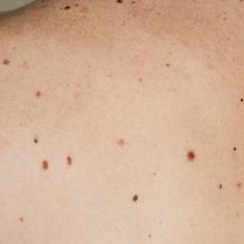 Skin Cancer: how UBIAD1 and Coenzyme Q10 protect melanoma
