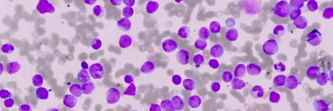 leukaemia under the microscope