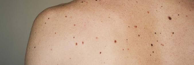 melanoma
