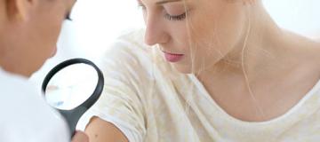 melanoma